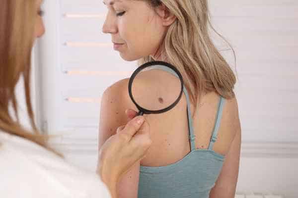 What Are Traditional Skin Lesion Removal Methods Canary Wharf?