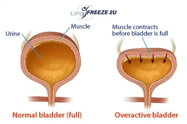 diagram of overactive bladder treatment Canary Wharf