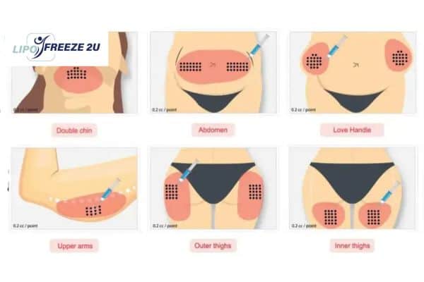 Benefits of Choosing Aqualyx for Fat Reduction Canary Wharf