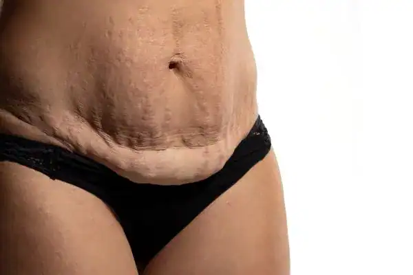 loose skin after weight loss injections Canary Wharf