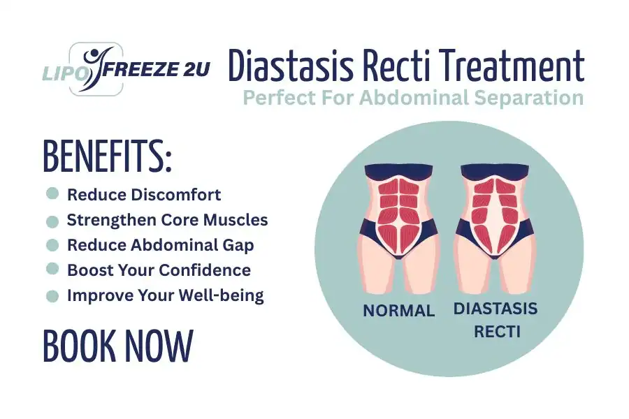 Benefits of body toning treatment Canary Wharf for Diastasis recti