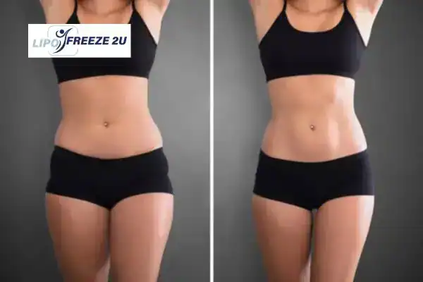 How Can LIPO FREEZE 2U Support Your Post-Pregnancy Body Recovery Canary Wharf?
