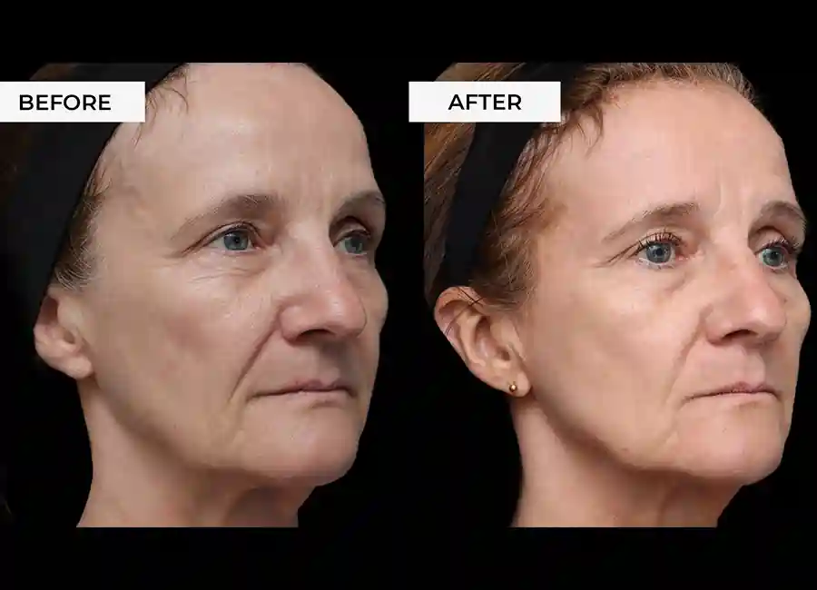 How Many RF Microneedling Sessions Will You Need to See a Difference Canary Wharf?