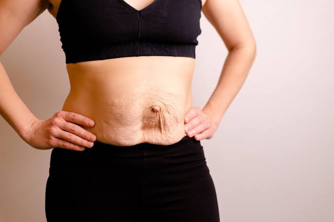 Is Surgery Really the Only Way to Repair Diastasis Recti Canary Wharf?