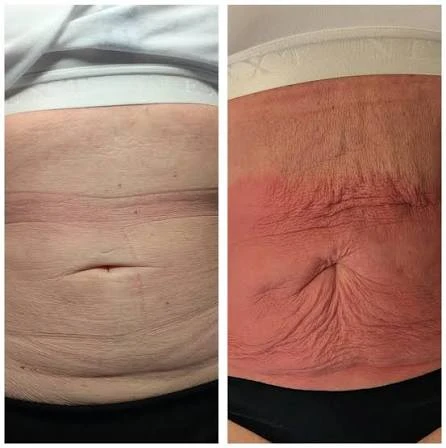 How Does RF Microneedling Improve Crepey, Thin and Uneven Skin Texture Canary Wharf?