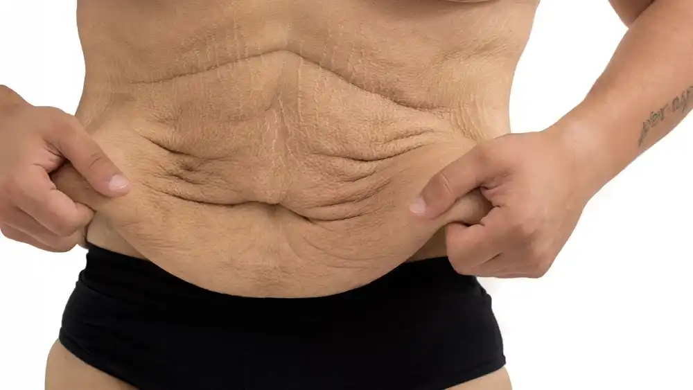 RF Microneedling for Loose Skin: How Can It Help Tighten and Reshape the Skin Canary Wharf?